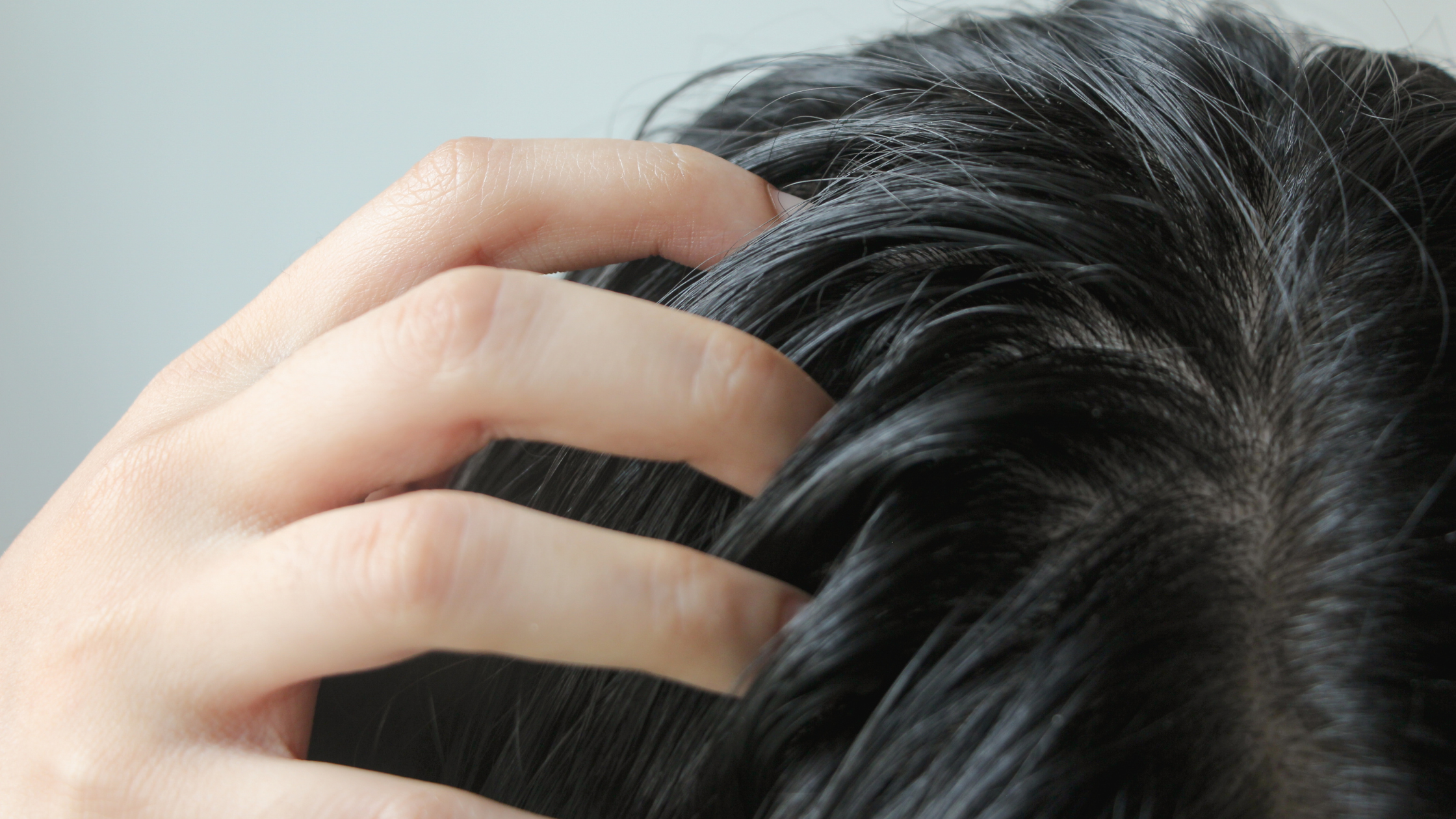 Close-up of scalp buildup causing greasy, flaky hair, a common sign a scalp treatment is needed
